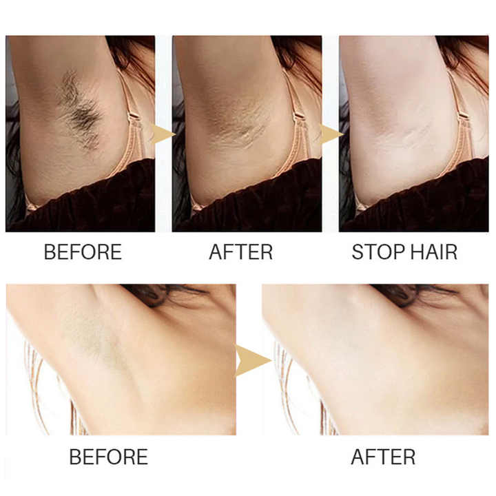 1+1 GRATIS | Smoothify™ Permanent haarverwijdering